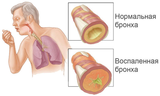 Лечение и профилактика воспаления бронхов