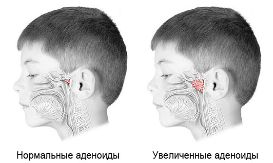 На какие симптомы аденоидов у детей стоит обратить внимание