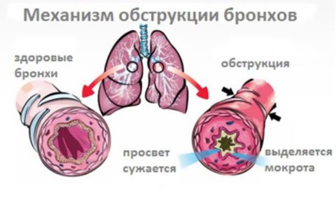 Лечение и профилактика воспаления бронхов