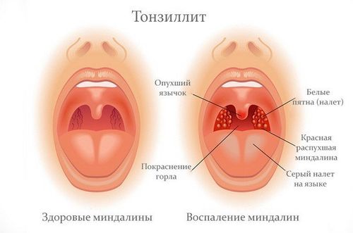 Белые и красные волдыри на задней стенке горла и миндалине