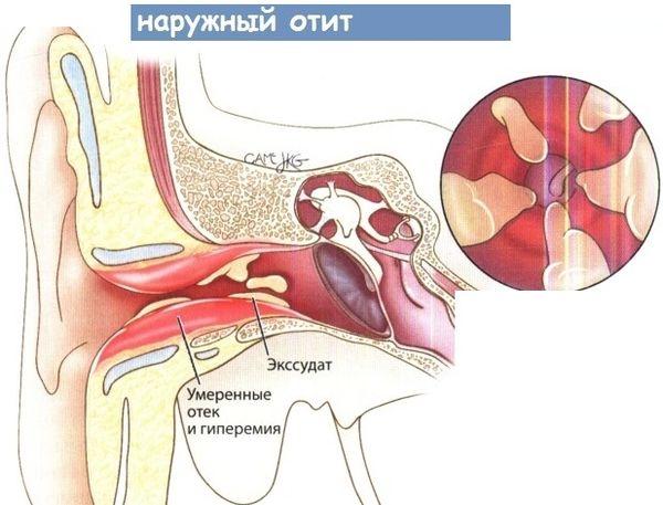 Жидкость в ухе причины, симптомы и особенности лечения