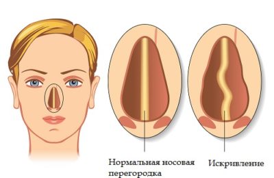 Причины и лечение храпа у мужчин