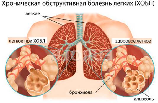 Обструктивный бронхит у детей