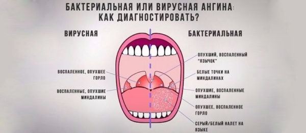 Особенности лечения бактериального тонзиллита