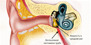 Тубоотит и евстахиит симптомы и лечение