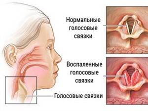 Сильно болит горло больно глотать и разговаривать, чем лечить