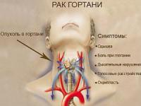 Первые признаки рака горла