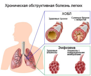 Причины и симптомы болезней легких у человека