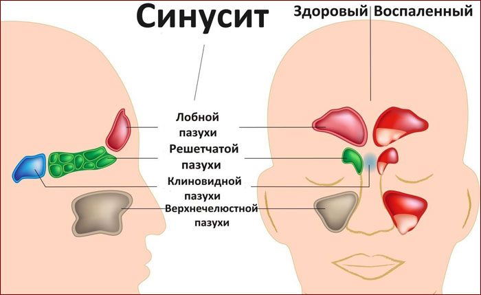 Боль в голове при кашле причины и лечение