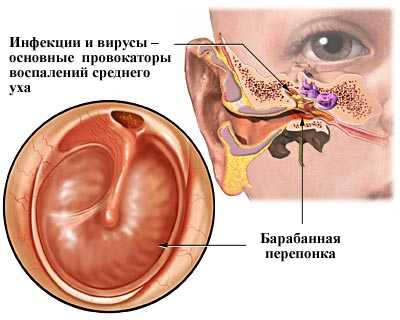 Причины гнойного отита