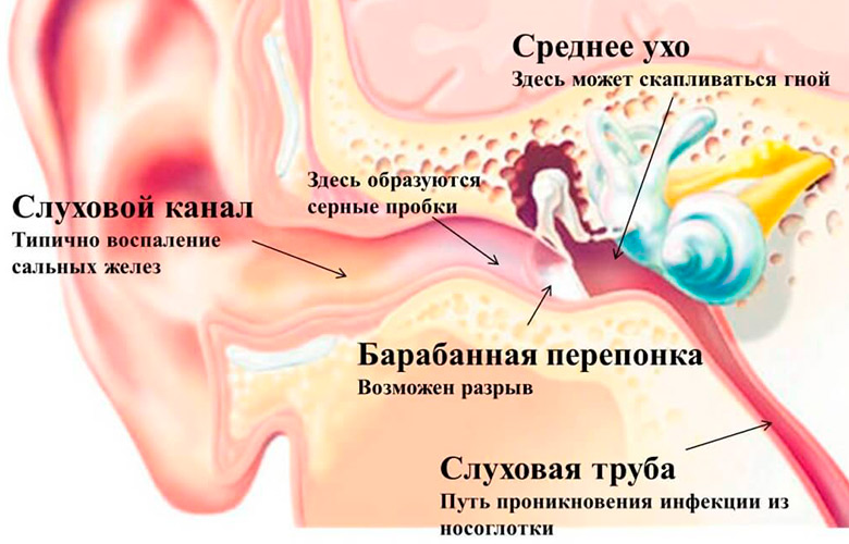 Причины лабиринтита и методы его лечения