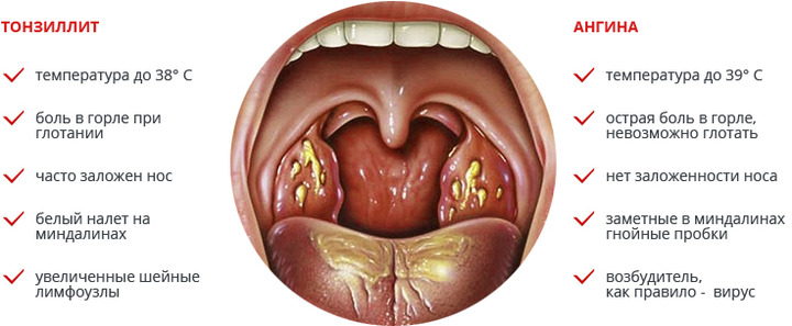 Болит горло слева при глотании и кашле