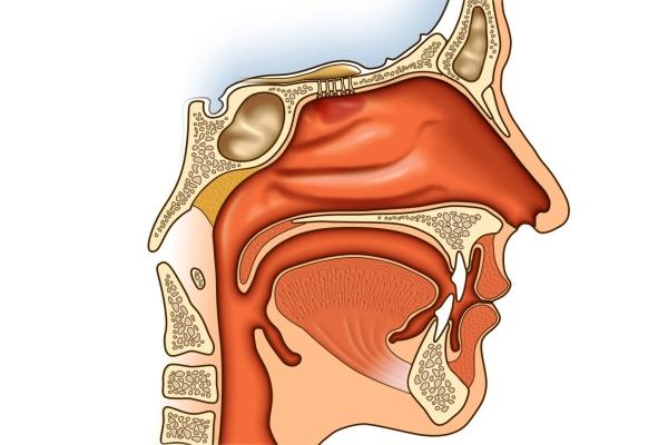 Симптомы рака носоглотки