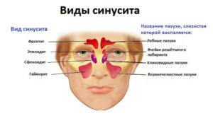 Симптомы, причины и лечение острого синусита у взрослых