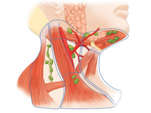 Причины воспаления и методы лечения подчелюстных лимфоузлов