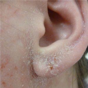 Эффективные методы избавления от перхоти в ушной раковине