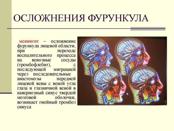 Осложнения фурункула