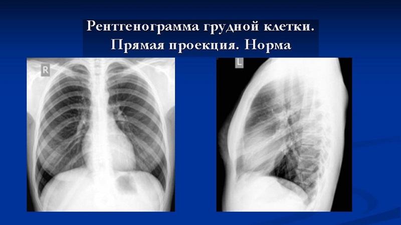 Рентгенография позвоночника