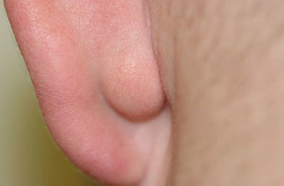 Причины появления жировика за ухом
