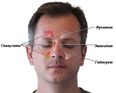 Какие признаки и как лечить катаральный синусит