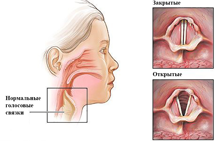 Как и чем лечить воспаление голосовых связок причины и профилактика недуга