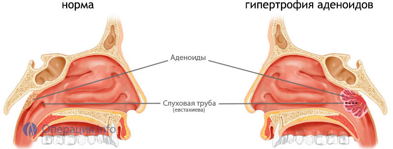 Методы удаления аденоидов у детей