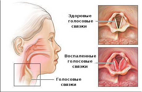 Симптомы ларингита, лечение и способы профилактики