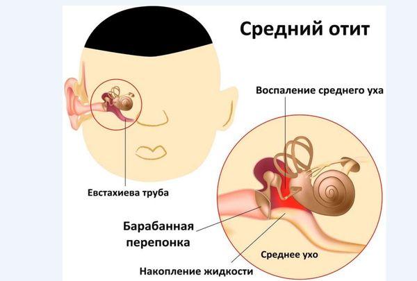 Причины, симптомы, стадии и лечение острого и хронического среднего отита