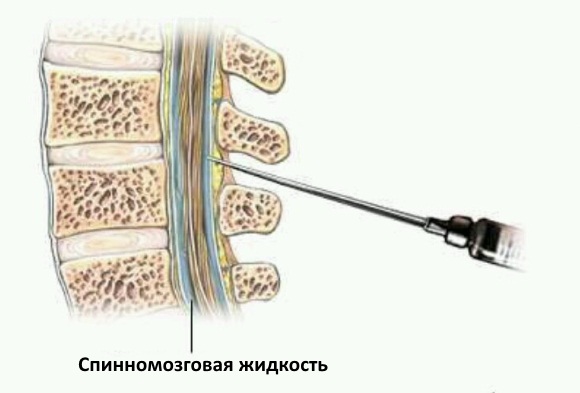 Спинномозговая пункция