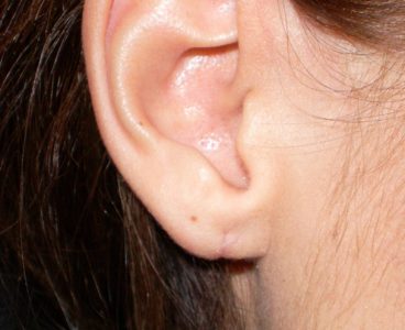 Шарик или шишка в мочке уха