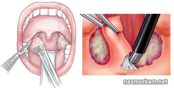 Симптомы тонзиллитных пробок