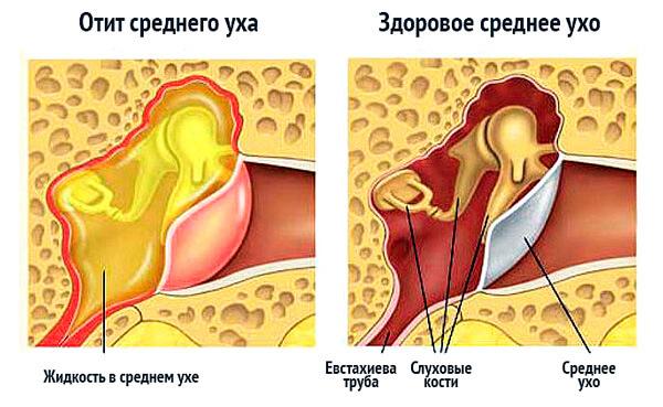 Шипит в ухе, но не причиняет боли