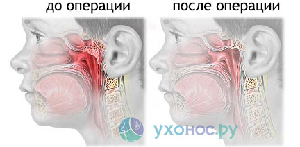 Причины появления аденоидов у детей