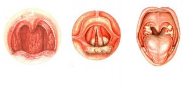Чем отличается фарингит от ларингита у взрослых, способы лечения