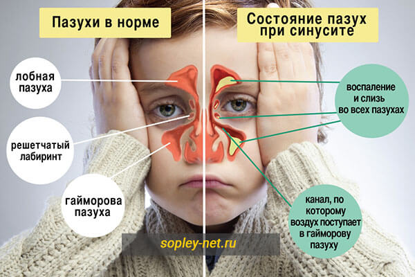 Розовые и оранжевые сопли из носа у взрослого, слизь в ноздрях