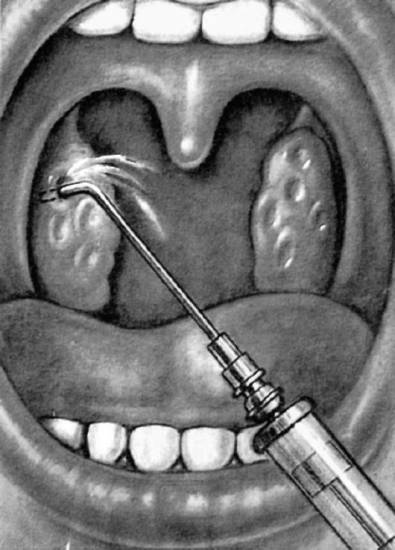 Способы лечения и осложнения при кисте миндалины