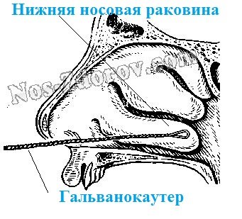 Когда необходимо провести процедуру прижигания кровеносных сосудов в носу