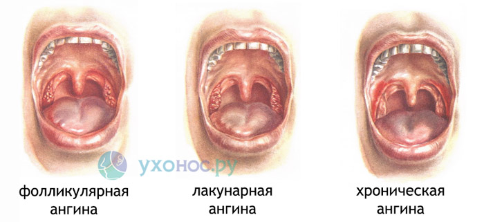 Лакунарная ангина симптомы лечение у взрослых