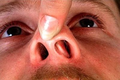 Как промыть нос Хлоргексидином при гайморите