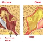 Осложнения после ангины