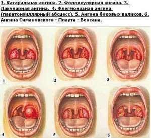 Хлорофиллипт масляный при ангине