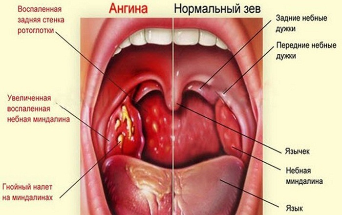 Боль при глотании в языке и горле