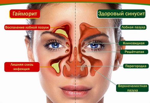 Здоровый синусит и гайморит