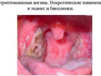 Стрептококковая ангина