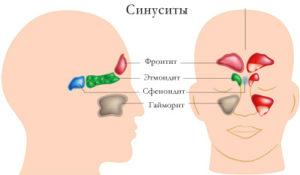 Симптомы и лечение двустороннего синусита