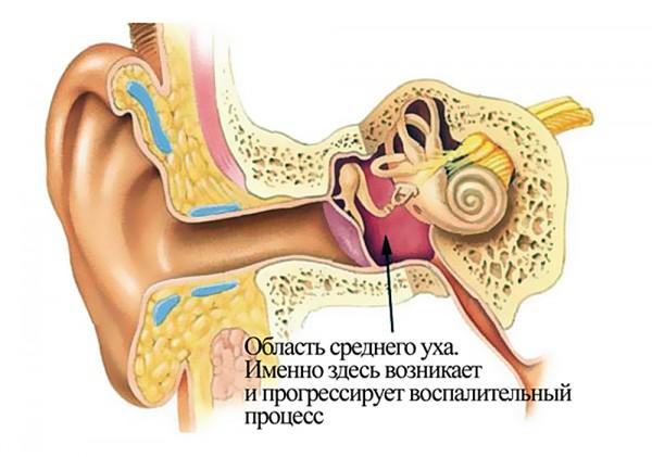 Хронический адгезивный средний отит симптомы и лечение