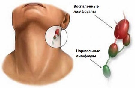 Основные меры профилактики дифтерии