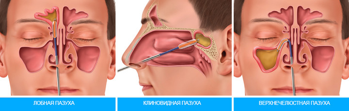 Пазухи околоносовые