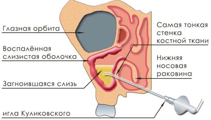 Схема прокола носовой пазухи при грибковом гайморите