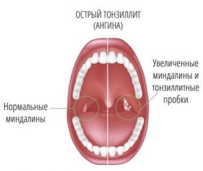 Лечение ангины у детей по методике доктора Комаровского